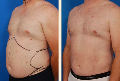 Say goodbye to stubborn belly fat Henley In Arden