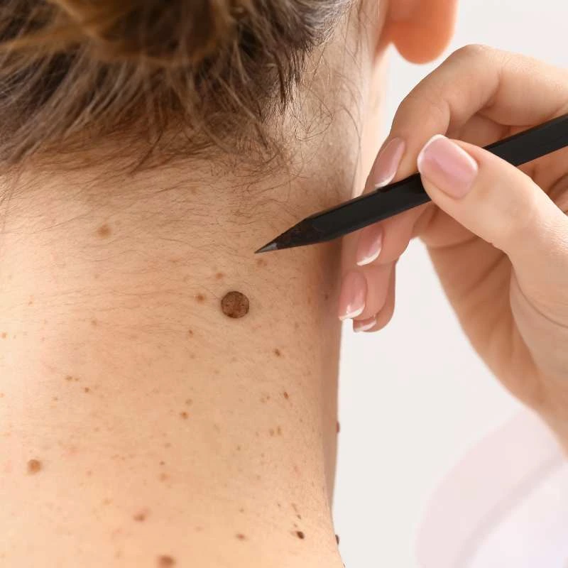 See our lesion removal prices Henley In Arden - call today for a free quote