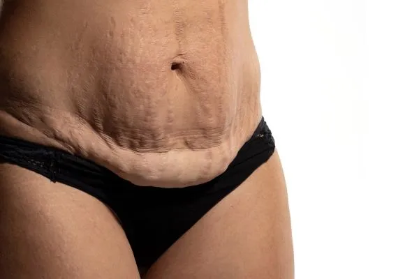 image of womans stomach after weight loss showing loose skin Henley In Arden 