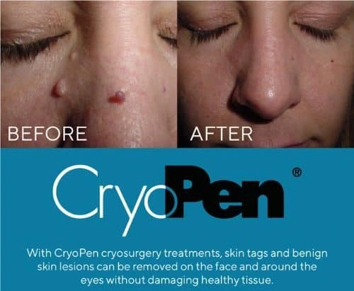image of angiofibroma removal Henley In Arden using Lipo Sculpt cryopen!