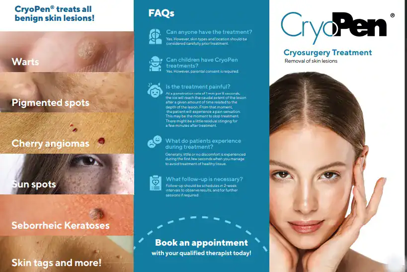 Benefits of Cryopen for seborrheic keratosis Removal Treatment Henley In Arden