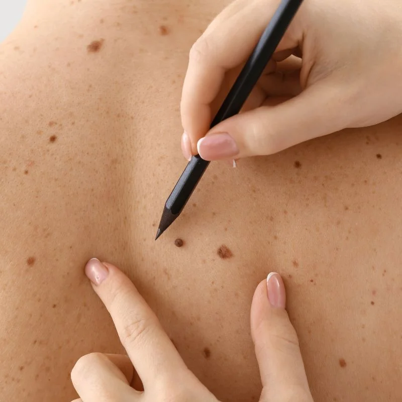 cryopen lesion removal treatment Henley In Arden