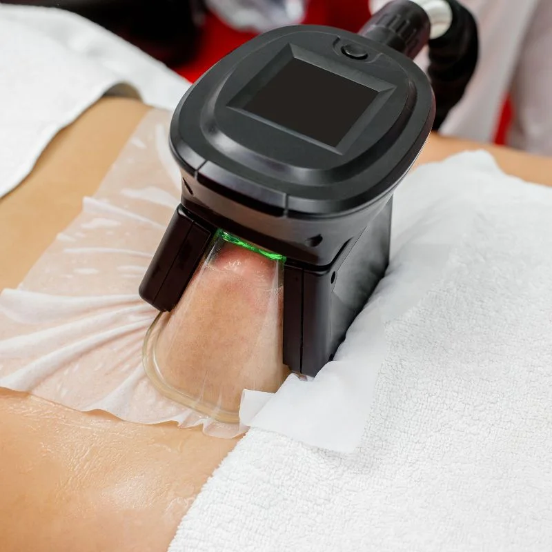 Fat Freezing treatment Henley In Arden